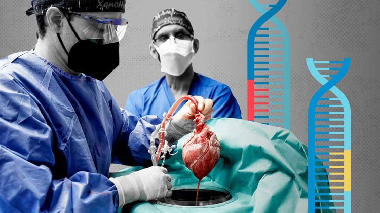 Kidney Transplant